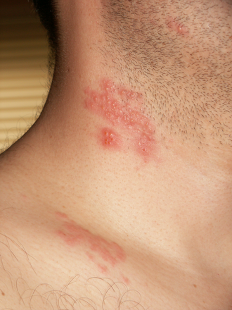 Herpes zoster — source media 2