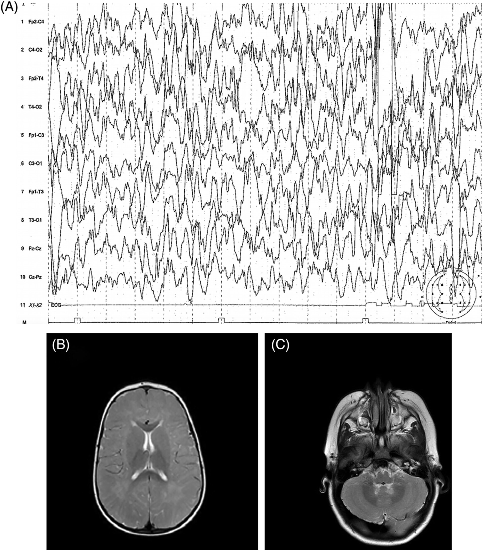 Hypsarrhythmia: chaotic, high-amplitude (>200 µV) multifocal spikes and slow waves… — source media 2