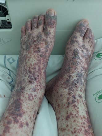 IgA vasculitis purpura — source media 2