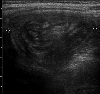 Intussusception target sign — source media 2
