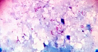 Acid fast bacilli — source media 2