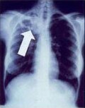 Cavitary tuberculosis — source media 3