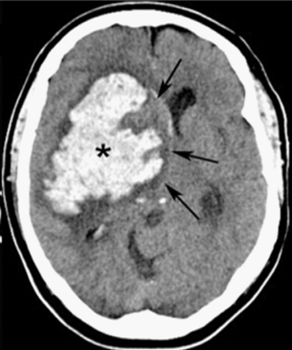 Intracerebral hemorrhage CT — source media 2