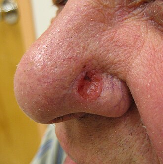 Basal cell carcinoma — source media 2