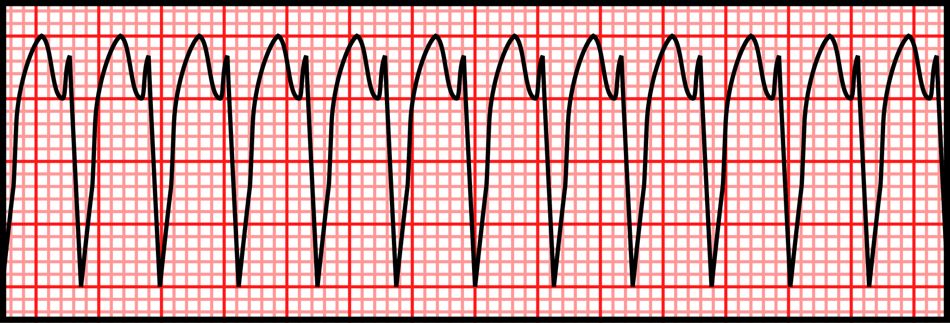 Ventricular tachycardia — source media 3