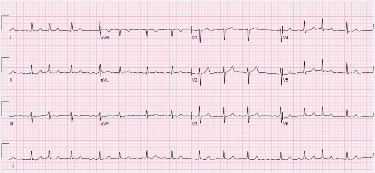 Atrial fibrillation — source media 2
