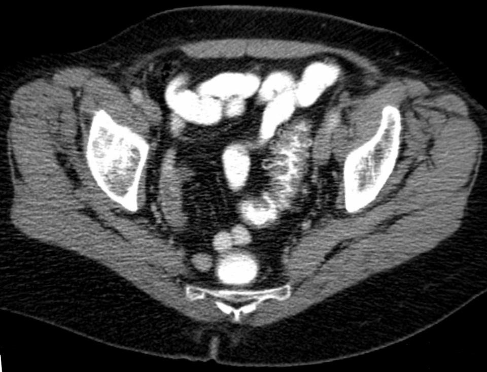 Sigmoid diverticulitis — source media 3