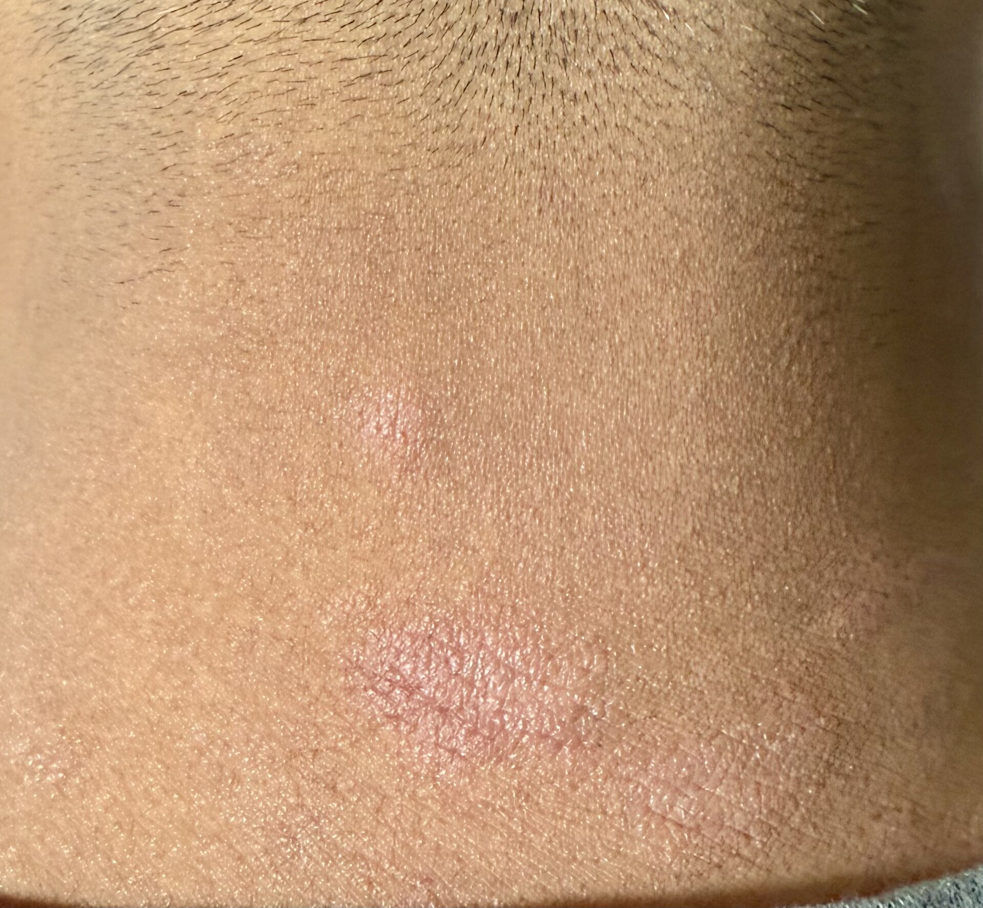 Tinea corporis — source media 2