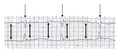 Complete heart block — source media 3