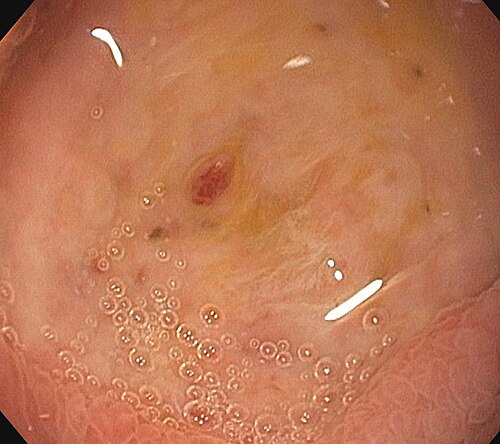 Bleeding peptic ulcers on endoscopy — source media 3