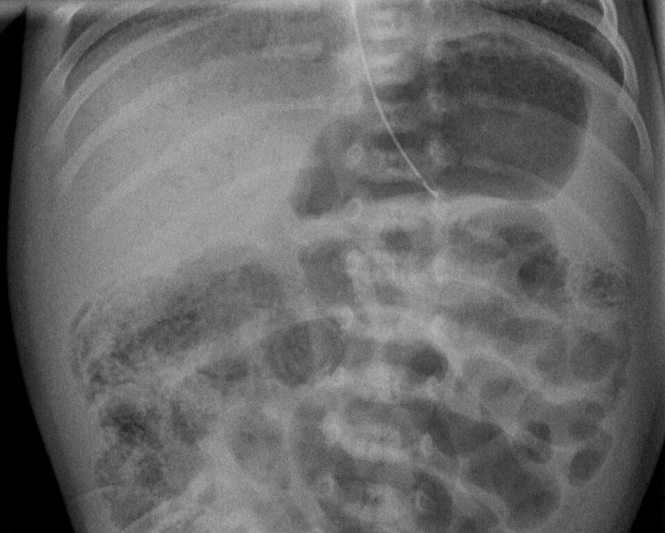 Necrotizing enterocolitis — source media 3