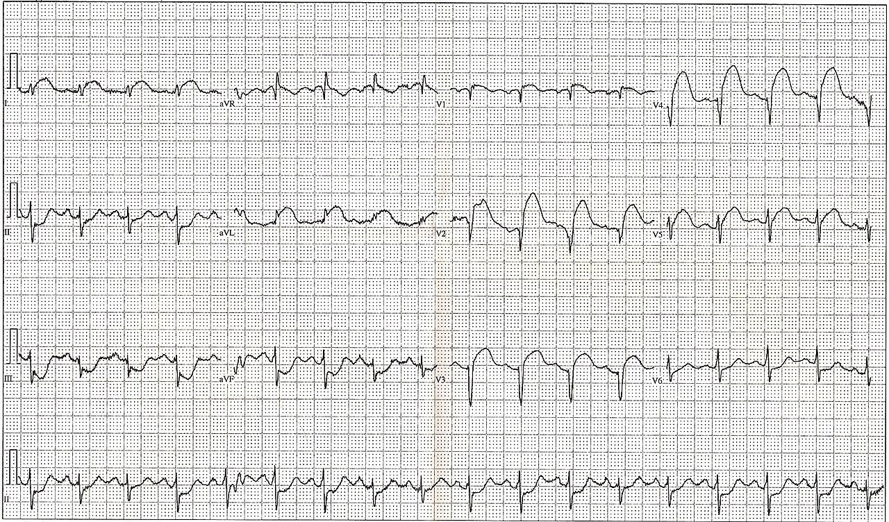 Anterior STEMI — source media 2