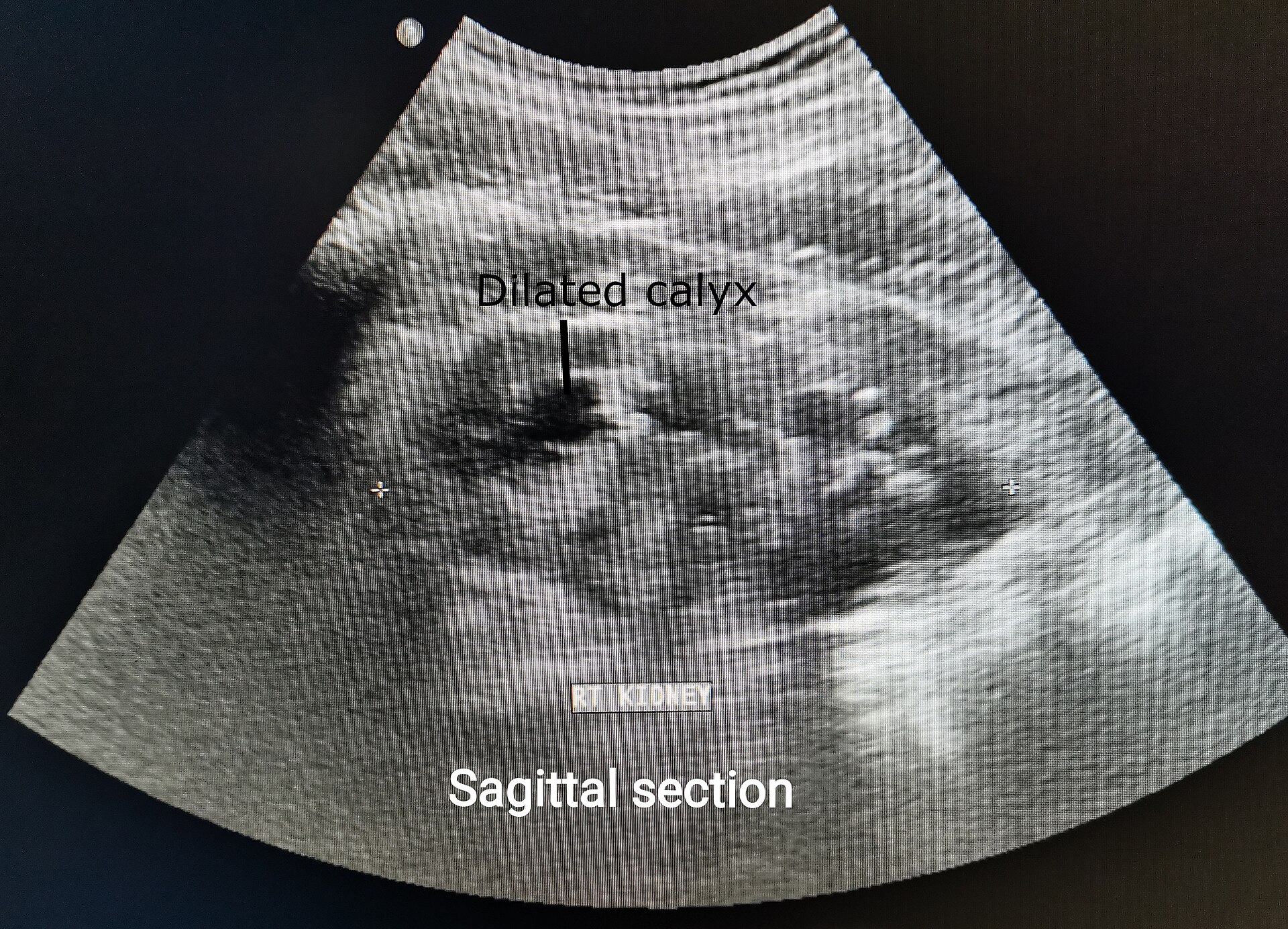 Hydronephrosis ultrasound — source media 2