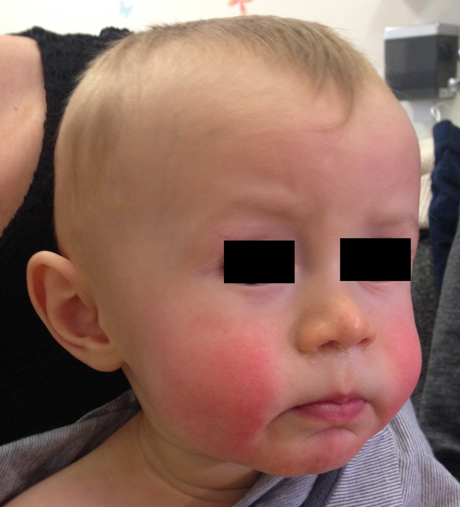 Erythema infectiosum — source media 2
