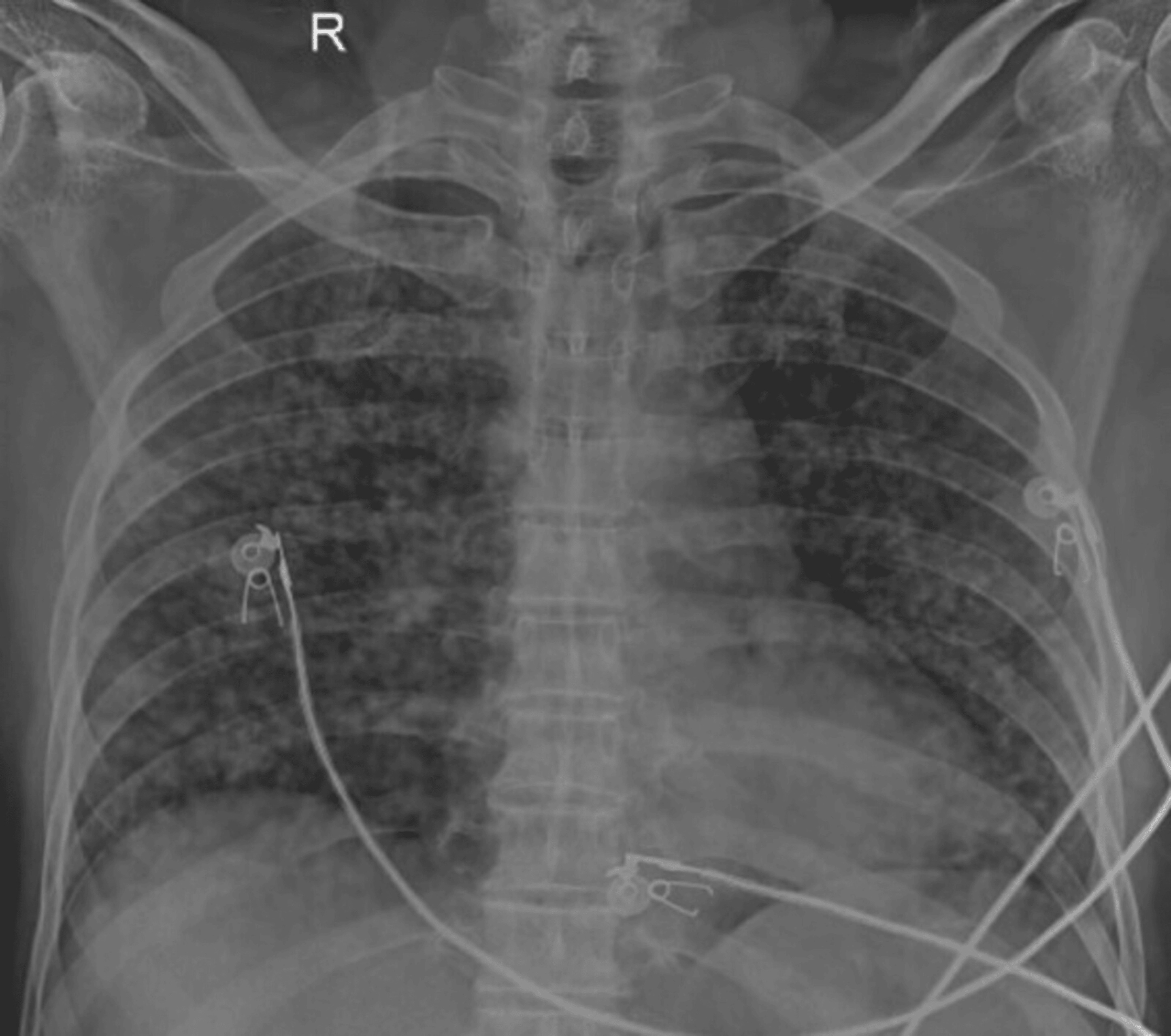 Miliary tuberculosis — source media 3
