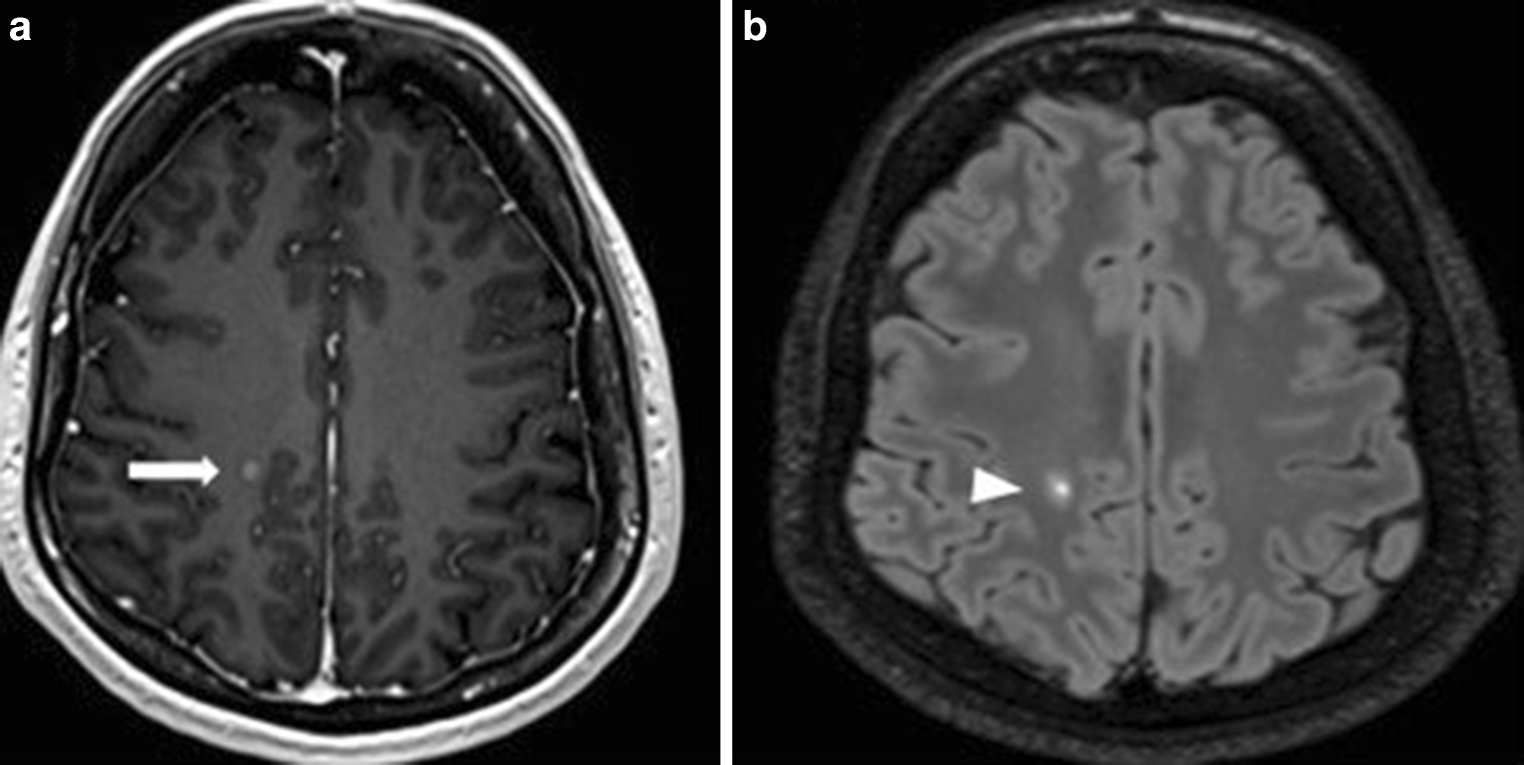 Multiple sclerosis MRI — source media 2