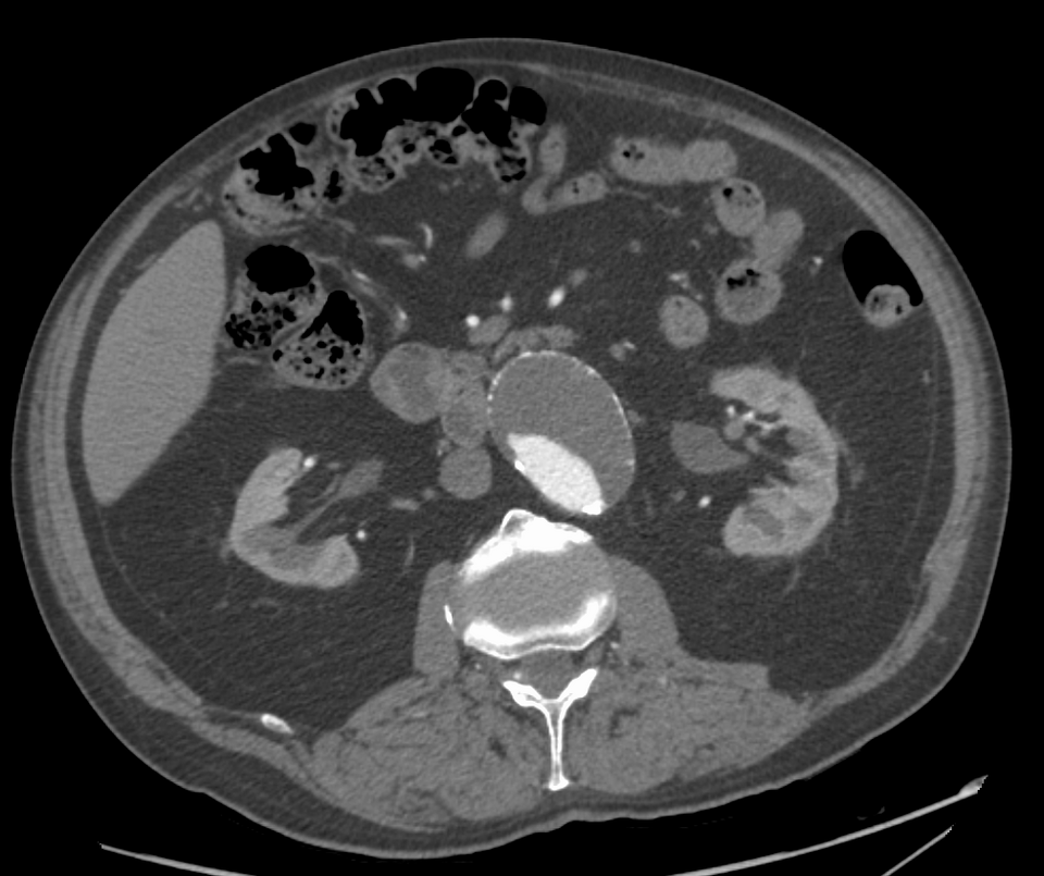 Abdominal aortic aneurysm — source media 2