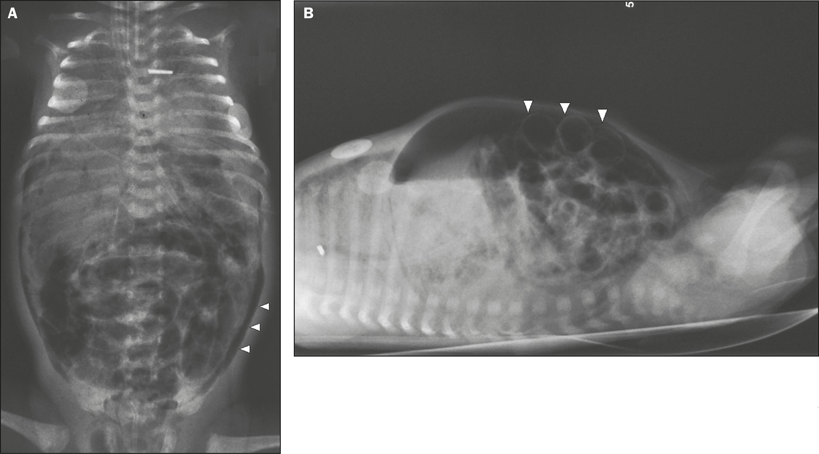 Necrotizing enterocolitis — source media 2