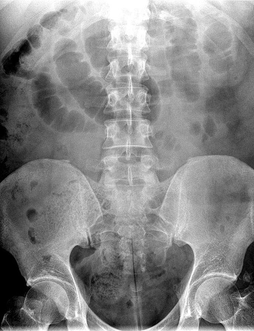 Small bowel obstruction — source media 3