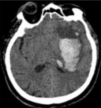 Intracerebral hemorrhage CT — source media 3