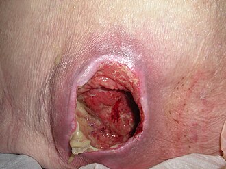 Pressure ulcer — source media 2