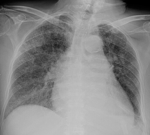 Miliary tuberculosis — source media 2