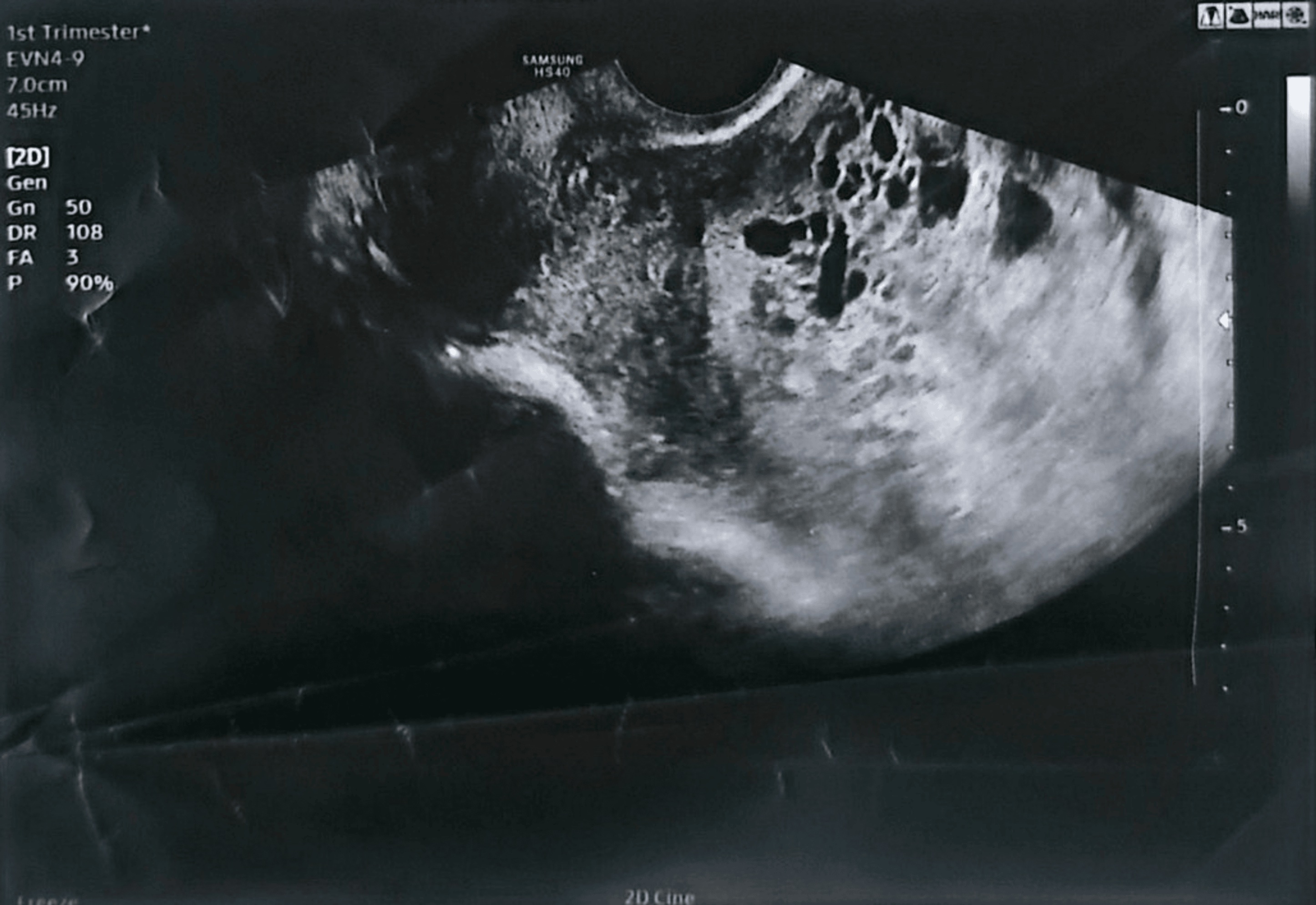 Hydatidiform mole ultrasound — source media 2