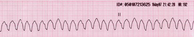Ventricular tachycardia — source media 2