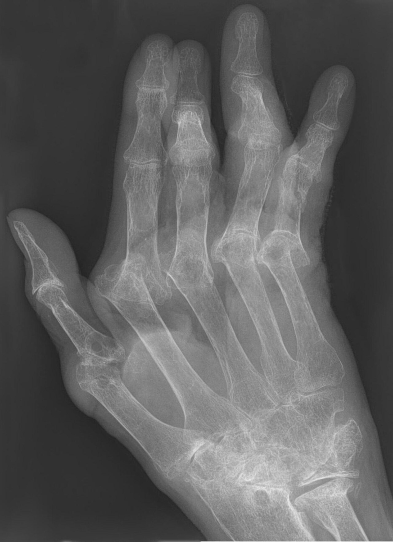 Rheumatoid arthritis hand — source media 3