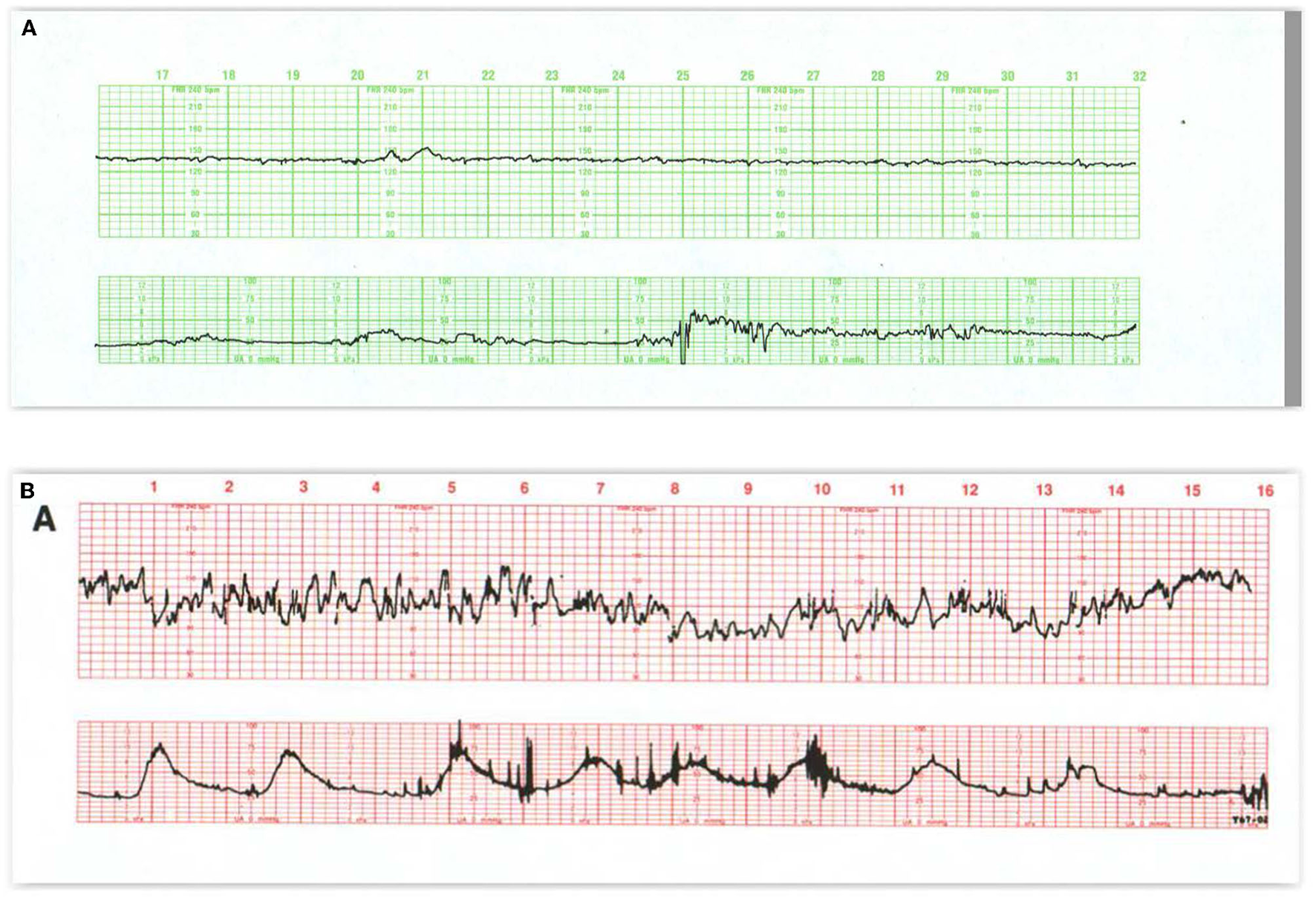 Prolonged fetal heart-rate deceleration — source media 2