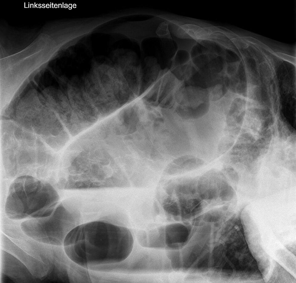 Sigmoid volvulus — source media 3