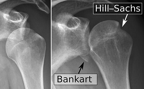 Anterior shoulder dislocation — source media 3