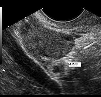 Ectopic pregnancy ultrasound — source media 3