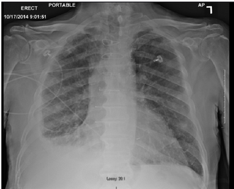Pleural effusion — source media 3