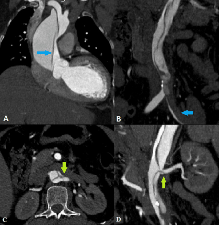 Type A aortic dissection intimal flap — source media 2