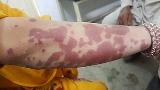 IgA vasculitis purpura — source media 3