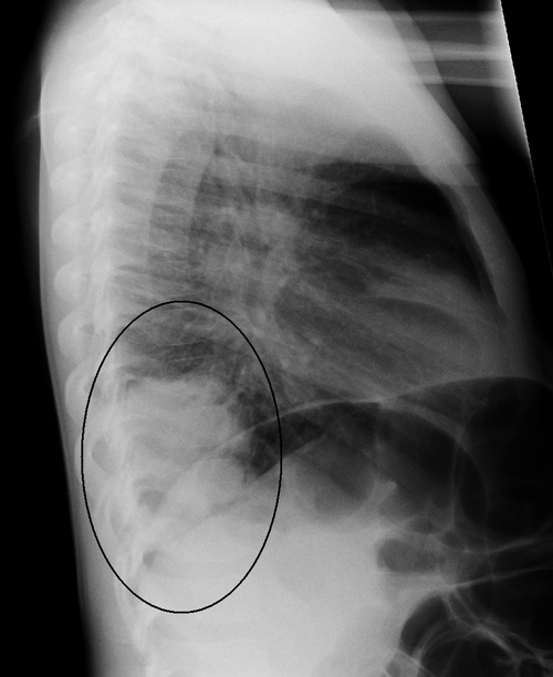 Lobar pneumonia — source media 3