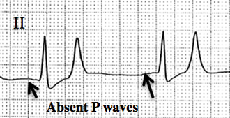 Hyperkalemia ECG — source media 2
