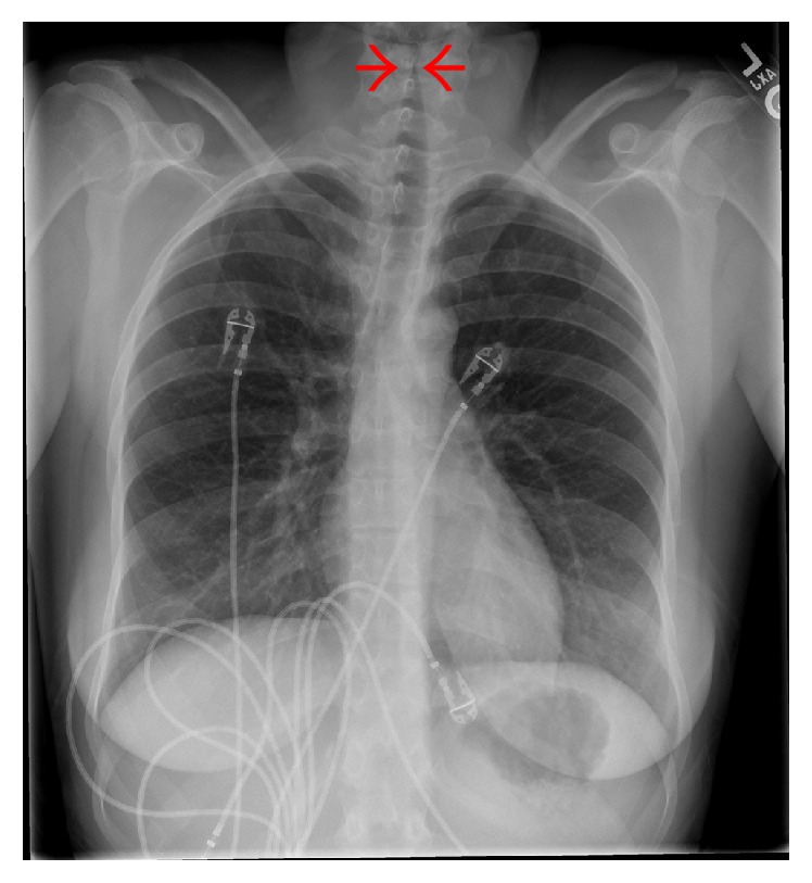 Epiglottitis and croup — source media 2