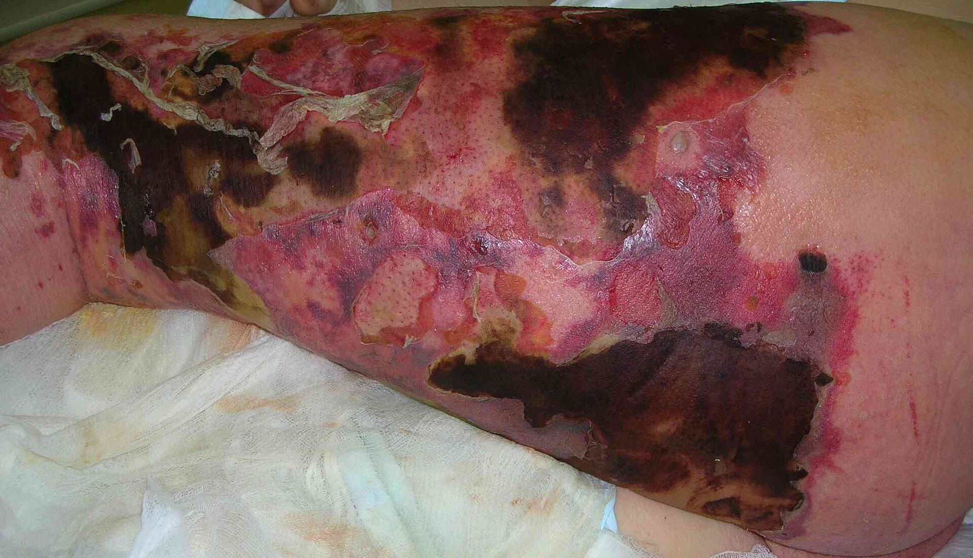 Necrotizing fasciitis — source media 2