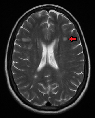 Multiple sclerosis MRI — source media 3