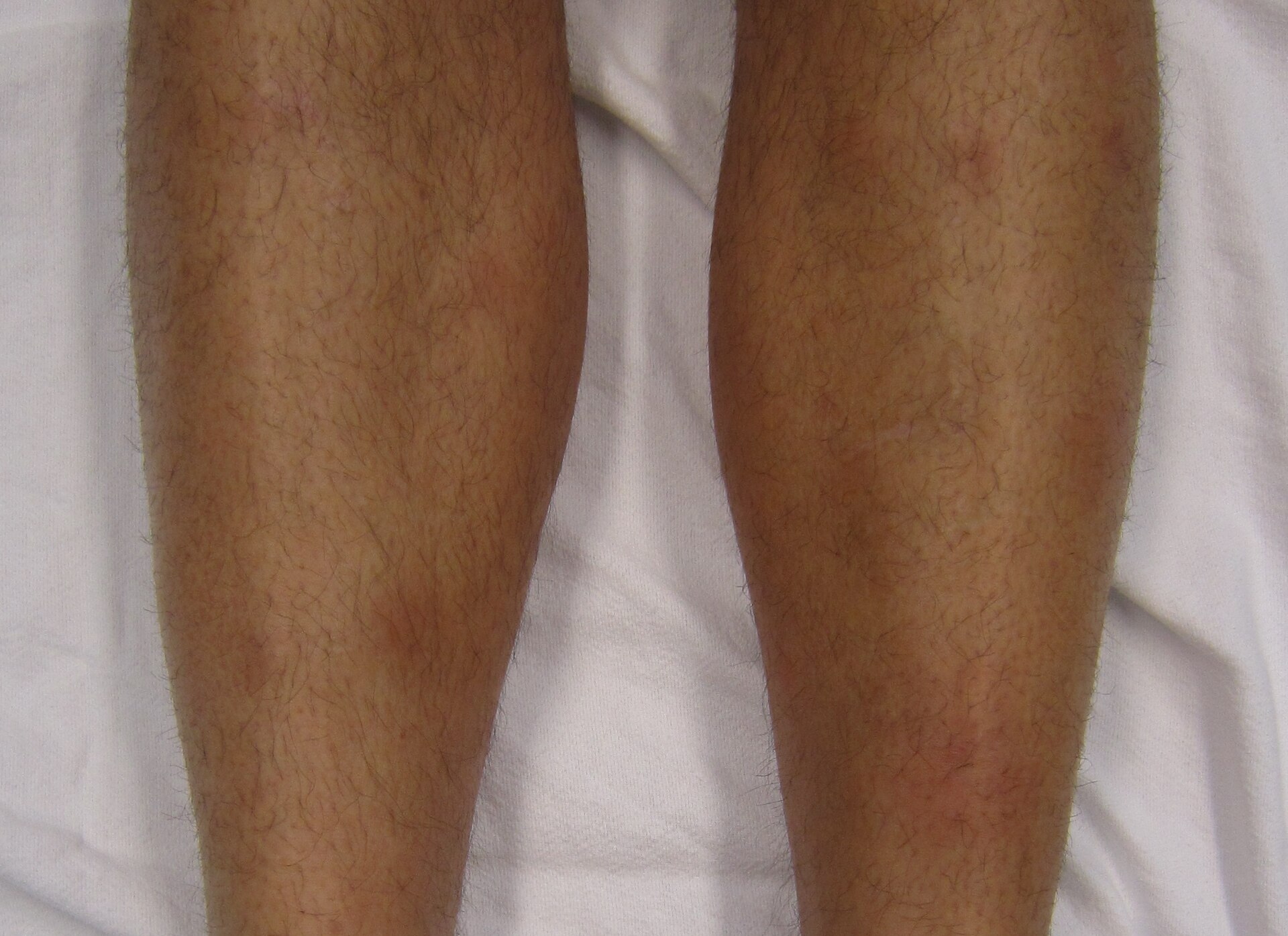 Erythema nodosum — source media 2