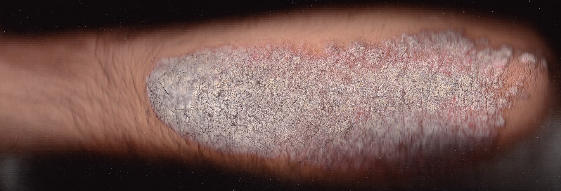 Plaque psoriasis — source media 2