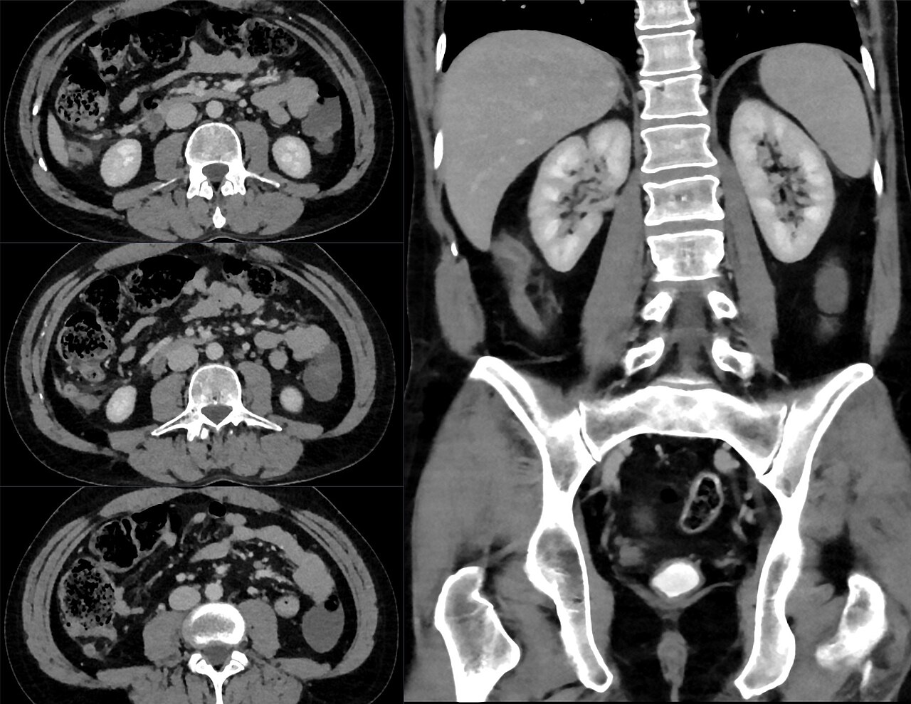 Acute appendicitis — source media 2