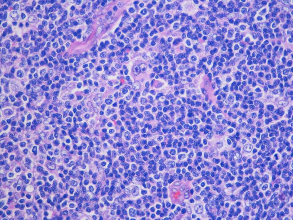 Reed Sternberg cell — source media 3
