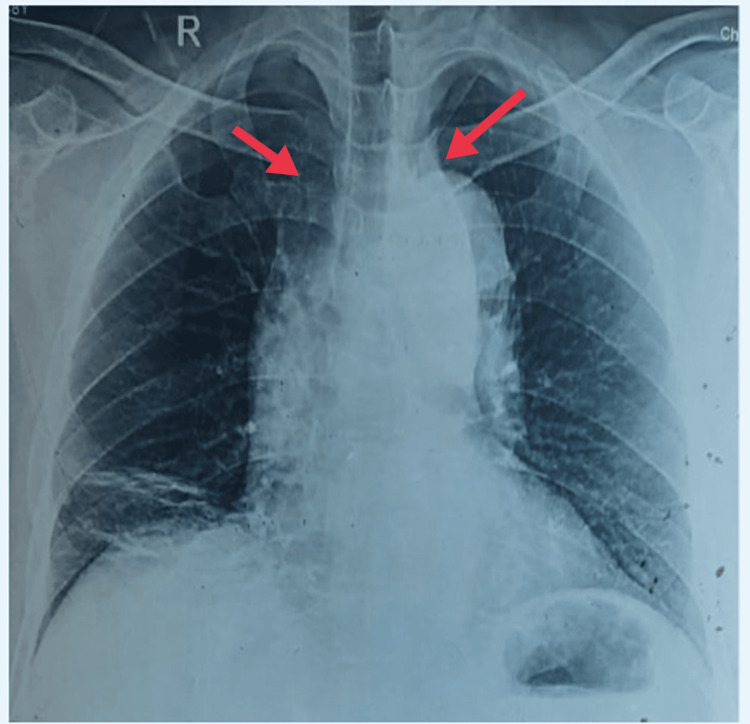 Aortic dissection — source media 2