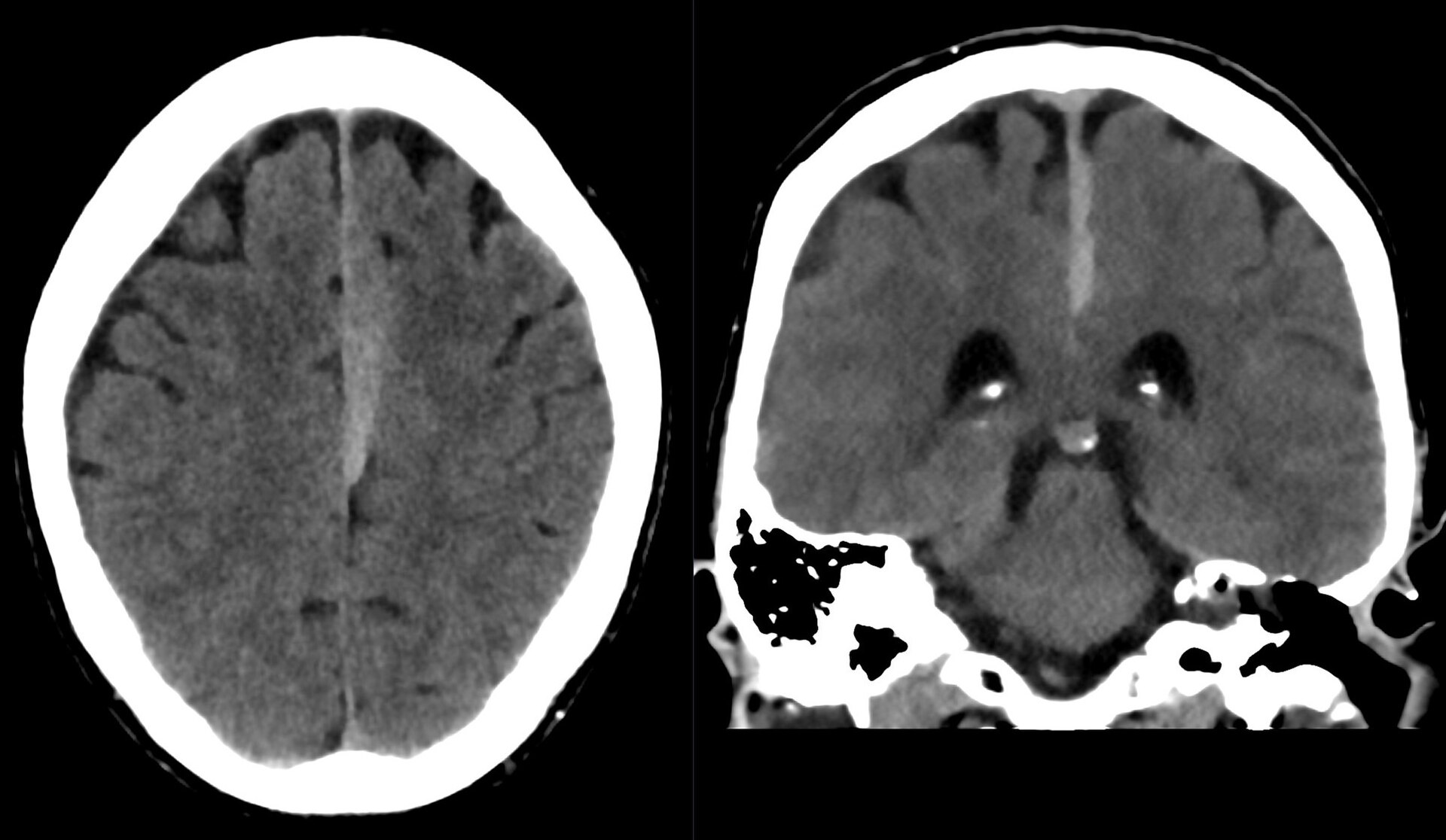 Subdural hematoma CT — source media 3