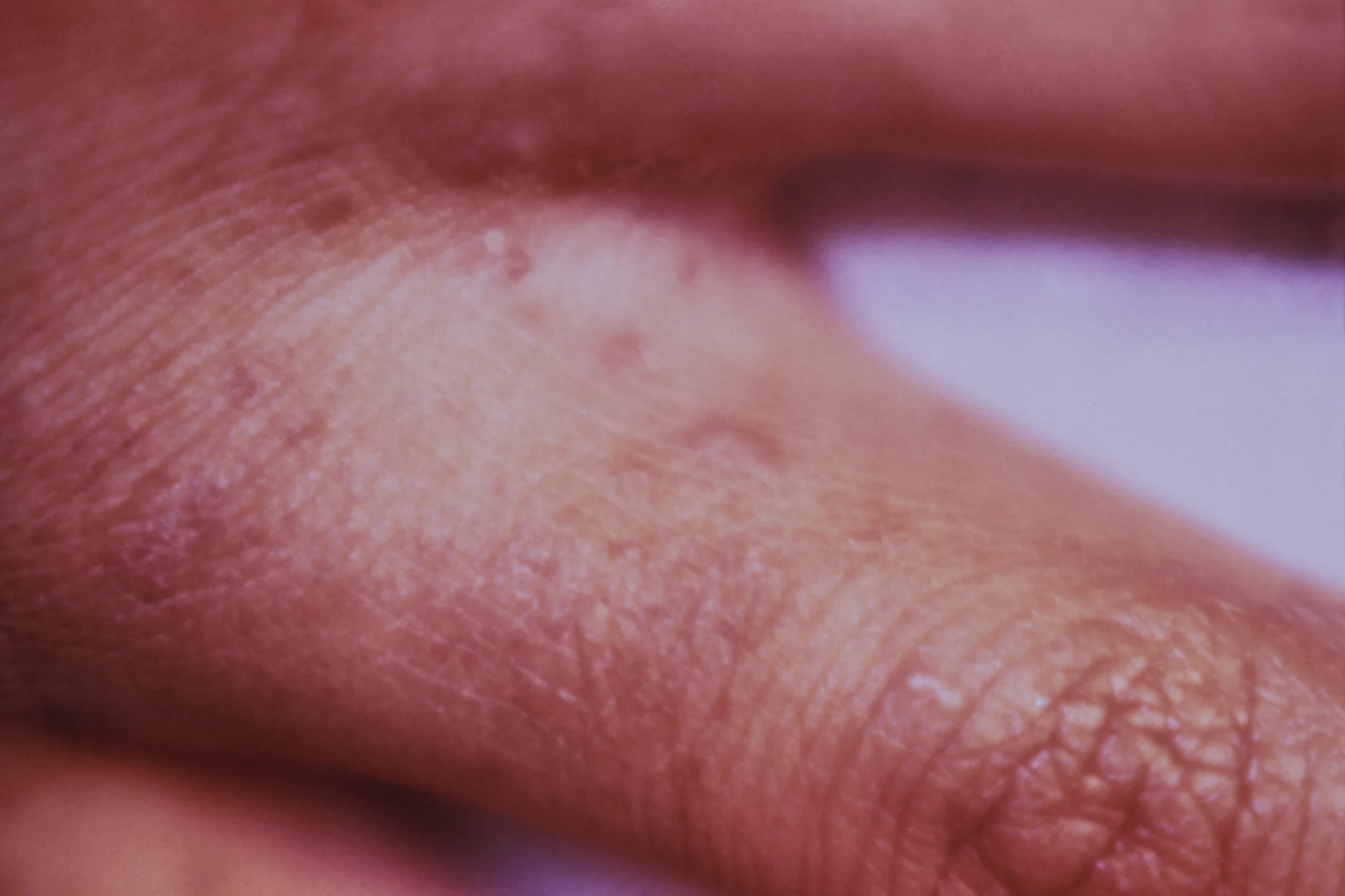 Scabies burrows — source media 2
