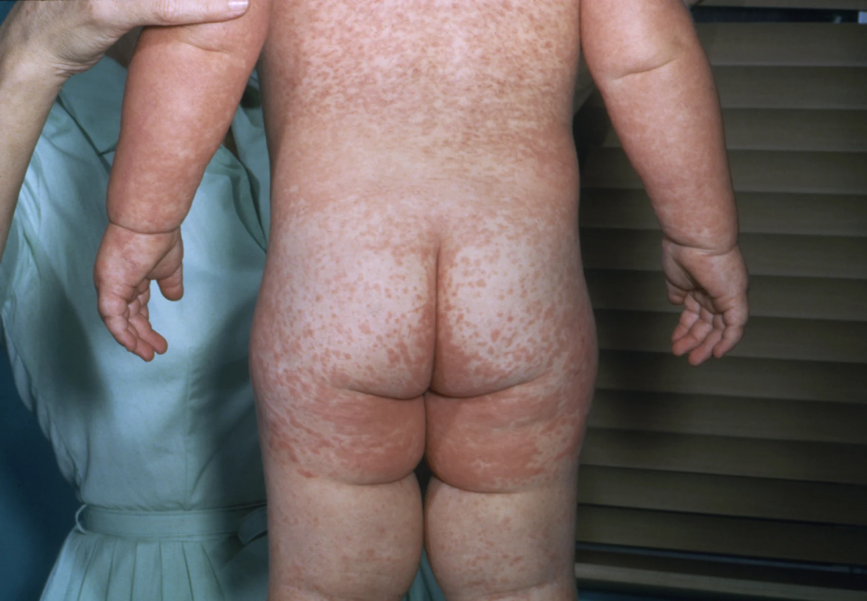 Measles rash — source media 2